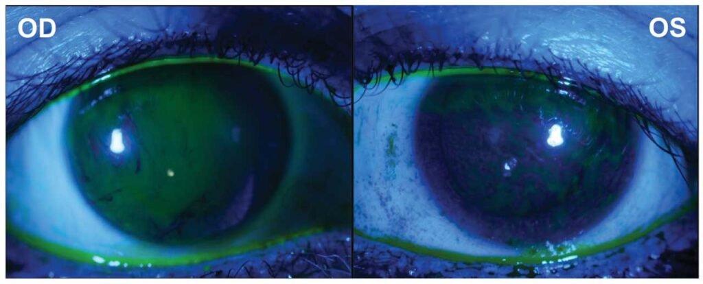 Dry Eyes Treatment in Karimnagar – Causes, Symptoms & Best Care Options