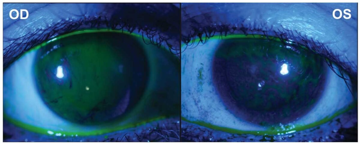 Dry Eyes Treatment in Karimnagar – Causes, Symptoms & Best Care Options