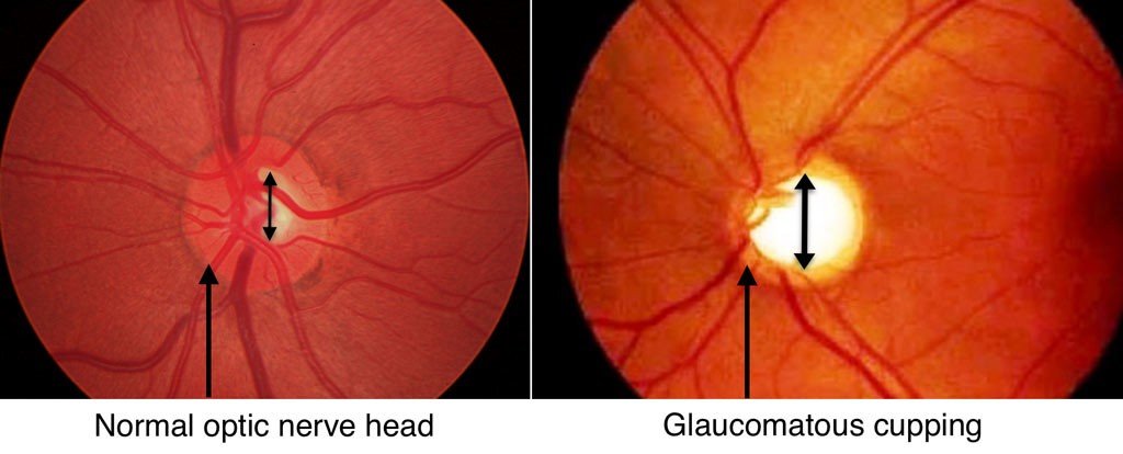 Glaucoma Treatment in Karimnagar – Early Symptoms, Causes & Eye Care Options