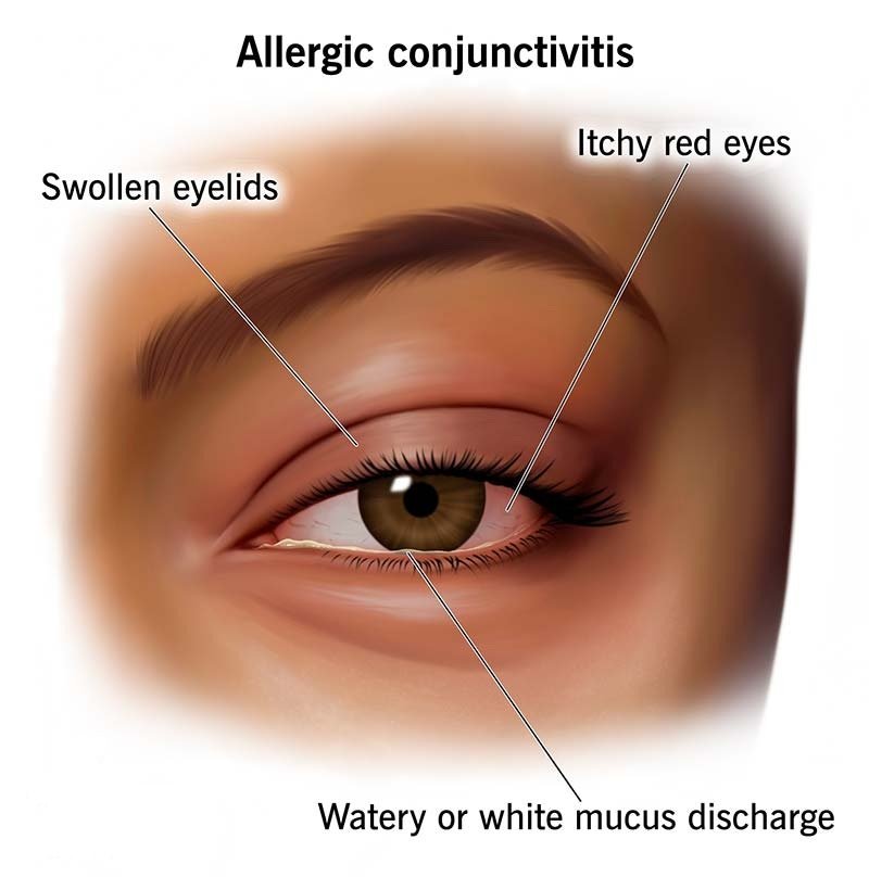 Eye Allergy Treatment in Karimnagar – Symptoms, Causes & Best Care Options