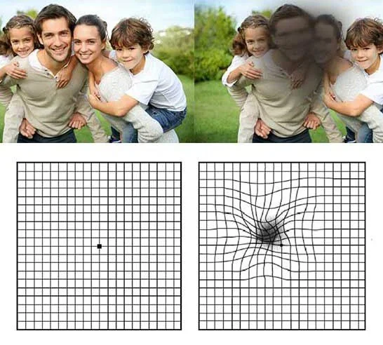 Macular Degeneration Symptoms and Treatment in Karimnagar – Early Detection Matters