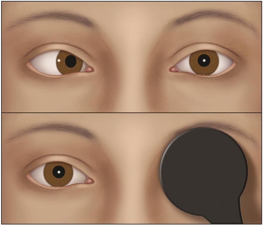 Squint Eye Treatment in Karimnagar – Causes, Symptoms & Modern Treatment Options